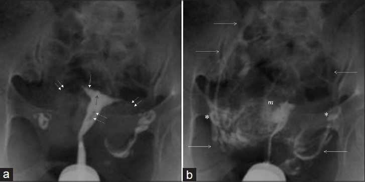 (a and b) 32-year-old women with uterus bicornis. Images show Moderate (Level 2) intravasation endometrial bulging (black arrow), myometrial enhancement depicting a fundal lobulation (f), patent tubes (double arrows), and peritoneal spillage (*).