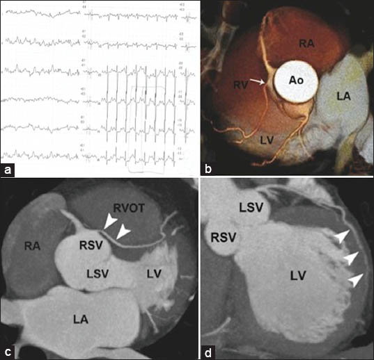 82-year-old man with positive ECG test but no symptoms diagnosed with an association of a malignant coronary artery anomaly of origin and course and a long myocardial bridging over the obtuse marginal branch. a) 12-lead electrocardiogram stress-test shows the 2 mm horizontal ST depression on leads V4 to V6, in absence of symptoms, during exercise. b) Multislice computed tomography (MSCT) with 3D volume rendering reconstruction reveals the abnormal origin of the left anterior descending (LAD) artery from the right sinus of valsalva (arrow). c) MSCT maximum intensity projection (MIP) reconstruction demonstrates the anomalous course of LAD artery (arrowheads) running between the aorta and the right ventricular outflow tract (malignant variant). d) MSCT MIP reconstruction illustrates the intramural course (“myocardial bridging“) of the obtuse marginal branch (arrowheads) within the left ventricular lateral wall. Ao: Ascending aorta, RVOT: Right ventricular outflow tract, LV: Left ventricle, RSV: Right sinus of valsalva, LA: Left atrium, RA: Right atrium, LSV: Left sinus of valsalva, LV: Left ventricle.