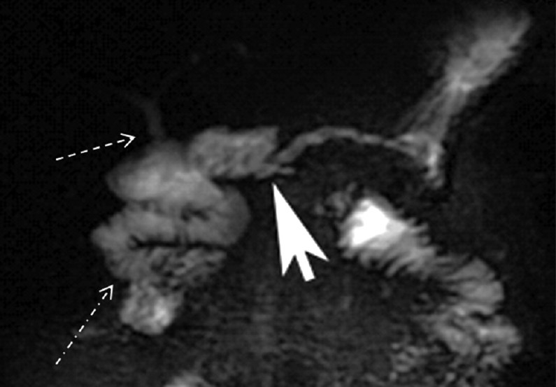 Post-secretin magnetic resonance cholangiopancreatography of a Whipple patient. Post-secretin MRCP image shows no significant change in the size of the main pancreatic duct but improved visualization of the pancreatico-jejunostomy (arrow head). Delineation of the choledochojejunostomy is also improved (dashed arrow). Dash-dot arrow shows increased fluid in the proximal jejunum.