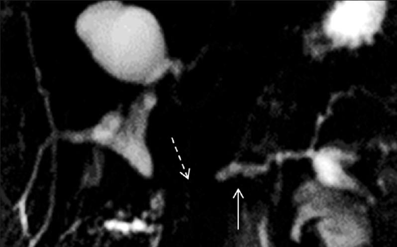 Pre-secretin magnetic resonance cholangiopancreatography in a patient with pancreato-jejunostomy. The main pancreatic duct is mildly dilated (arrow) with non-visualization of the pancreato-jejunostomy (dashed arrow).