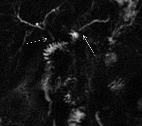 Pre-secretin magnetic resonance cholangiopancreatography Whipple. The image shows pancreato-jejunostomy (arrow) and choledocho-jejunostomy (dashed arrow).
