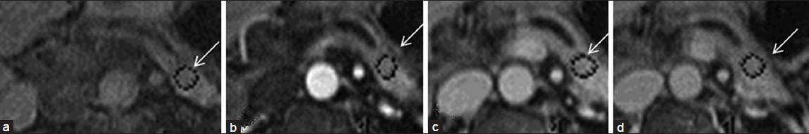 Pre- and dynamic post- gadolinium images of a patient with chronic pancreatitis. (a) Non-contrast image shows low T1 signal intensity within the pancreas (arrow) compatible with chronic pancreatitis. Subsequently (b, c), there is a slow rise to peak enhancement. (d) delayed phase demonstrates a slow washout within the pancreas compatible with pancreatic fibrosis.