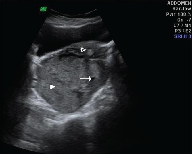 Trans-abdominal ultrasonogram in a 40-year-old woman at the level of urinary bladder shows mixed echogenic, predominantly hyperechoic lesion in pouch of Douglas displacing the uterus (empty arrowhead) anteriorly and cystic (arrow) and solid components (solid arrowhead) within the lesion.