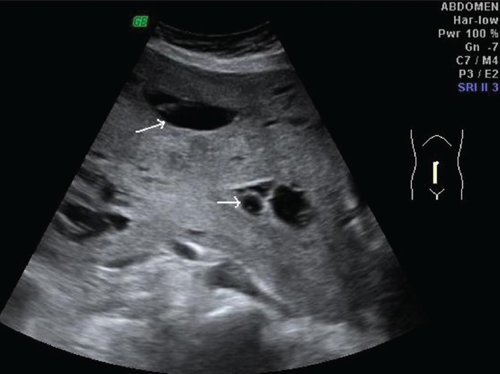 Longitudinal scan reveals cranial extension of lesion up to umbilicus with multiple internal cystic components (arrows).