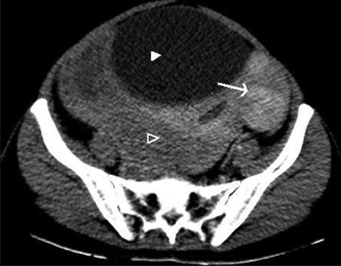 Axial contrast-enhanced computed tomographic scan section at the level of urinary bladder (solid arrowhead) shows displacement of uterus anterolaterally (arrow) and mixed density mass posteriorly (empty arrowhead).