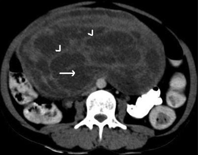 Axial contrast-enhanced computed tomographic scan at a higher level reveals thick enhancing septae (arrowheads) and cystic components (arrow).