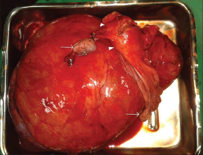 Gross surgically removed specimen of giant fibroid in the right broad ligament with normal ovaries (arrows) and uterus (arrow head).