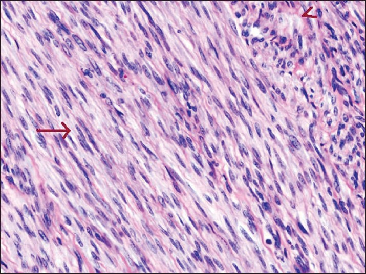 Microscopic examination of the surgically removed specimen found in the right broad ligament demonstrates interlacing bundles of smooth muscle cells (arrow), scattered thick walled blood vessels, and evidence of cystic, myxoid, and hyaline degeneration (arrowhead) (Hematoxylin and eosin, ×100)..