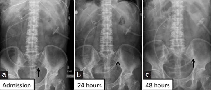 Case 1: Sequential abdominal radiographs show mild proximal small bowel dilatation reported as post-operative ileus: (a) On admission, (b) 24 hours later and (c) 48 hours later. Black arrow indicates the distal tip of the percutaneous jejunostomy feeding tube in all sequential radiographs.