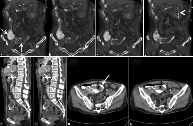 Case 1: (a - d) Coronal CT slices with contrast via feeding tube, progressing from posterior to anterior of the patient, demonstrating the intussusception with the GJ tube as an anatomic lead point (Figure 2a, dashed white line). The white solid line (Figure 2a) depicts the distal portion of the intussusception and arrowhead in d points to the tube. (e and f) Sagittal images that show intussusception in the distal small bowel. (g and h) Axial CT images of the abdomen that show a loop of distal small bowel (star) engulfed within another segment (Figure g, white arrow).