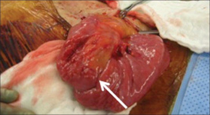 Case 1: Gross specimen shows a reverse long segment intussusception with distal bowel telescoping into a proximal segment (white arrow).