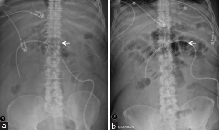 Case 2: (a) Supine and (b) semi-upright abdominal radiographs demonstrate scattered, mildly dilated small bowel loops without significant air fluid levels. Radiographs read as mild ileus pattern. Due to progression of abdominal pain, CT of the abdomen and pelvis was ordered, which illustrated a long loop intussusception over the percutaneous jejunostomy feeding tube. The feeding tube was a Kendel 12 French feeding jejunostomy tube.