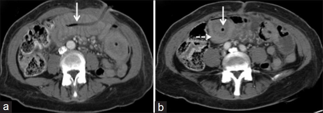 Case 2: (a and b) Axial CT images, with IV contrast introduced peripherally and without bowel contrast. CT images of the patient demonstrate distal tip of the percutaneous jejunostomy tube (white arrow) within the distal small bowel. Figure 5b illustrates a lower attenuating surrounding area around the tip (white arrow). Encircling that focal area is a larger bowel segment (intussuscipiens) with higher attenuation (dashed white arrow).