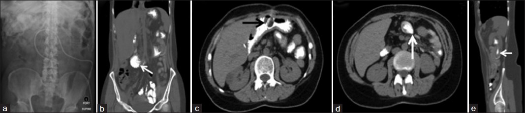 Case 3: (a) Supine abdominal film, shows mildly dilated small bowel in the left upper abdomen. (b) Coronal CT image depicts the percutaneous tube within a distal segment of small bowel. (c and d) Axial CT images of the abdomen. Figure 6c shows the intussusception (black arrow). Figure 6d (white arrow) shows the tube at a higher level. (e) Sagittal CT characterize the intussusception again (note that in this sagittal image the abdominal entry point of the tube is not visualized).
