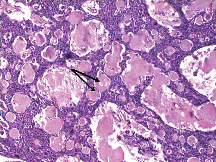 calcifying odontogenic cyst histopathology