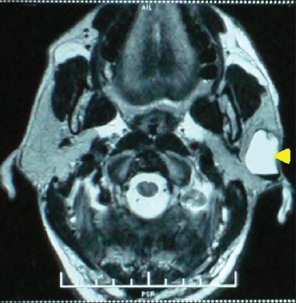 submandibular gland cyst