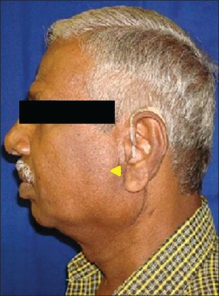 submandibular gland cyst