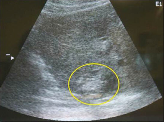 Longitudinal ultrasound scan of the liver shows the characteristic hyperechoic lesion created with radiofrequency ablation. These lesions were created within 1 cm of the liver dome.