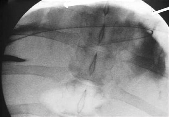 Anteroposterior fluoroscopic image of the abdomen demonstrates the wire (arrows) passing over the hepatic dome from a right lateral percutaneous approach. Contrast is seen opacifying the correct location of the peritoneal cavity.