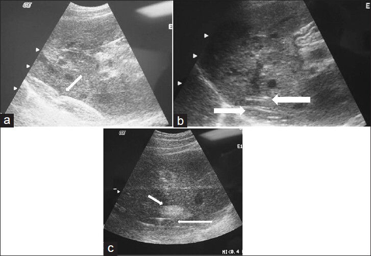 (a) Longitudinal ultrasound view of the liver shows the positioning and placement of the inflated balloon catheter (arrow). (b) Longitudinal ultrasound view of the liver shows the radiofrequency ablation prongs deployed within 1 cm of the liver surface. The balloon catheter is seen interposed between the liver surface and the diaphragmatic edge (arrow). (c) Longitudinal ultrasound shows the characteristic echogenic focus corresponding to the ablated lesion (short arrow) created in close proximity to the inflated protective balloon (long arrow).