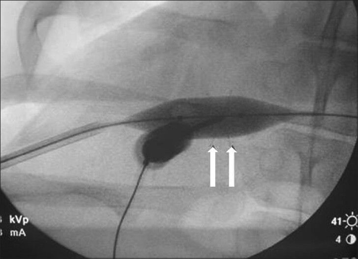 Magnified anteroposterior fluoroscopic view of the liver demonstrates the balloon inflated during radiofrequency ablation prong deployment.