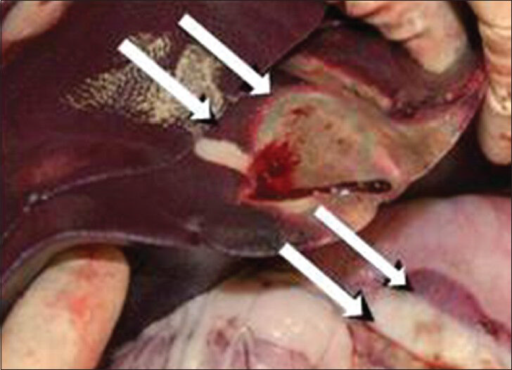 Gross picture of the bowel shows discolored segment of bowel caused from radiofrequency ablation of adjacent liver.