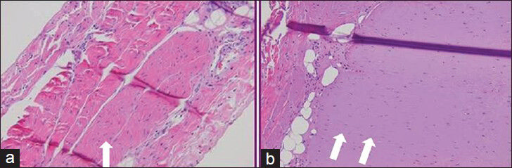 Histologic specimens stained with hematoxylin and eosin staining (a) from balloon protected diaphragm shows no evidence of injury. (b) from lesion in the diaphragm created without protective balloon demonstrates Grade 3 type injury with a paucity of nuclei.