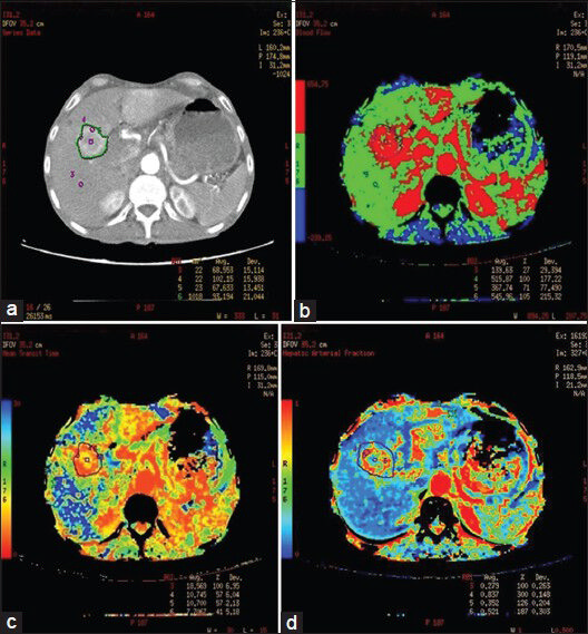 60-year-old male who was a known case of cancer stomach with secondaries in the liver. (a) Postcontrast CT, (b) BF, (c) MTT and (d) HAF maps of the liver. Postcontrast CT shows peripheral rim enhancement of lesion with central necrosis. Perfusion maps show increased BF (515.8 ml/100 g/s) and HAF (83.7%) with decreased MTT (10.7 s) at the periphery of lesion as compared with background liver.