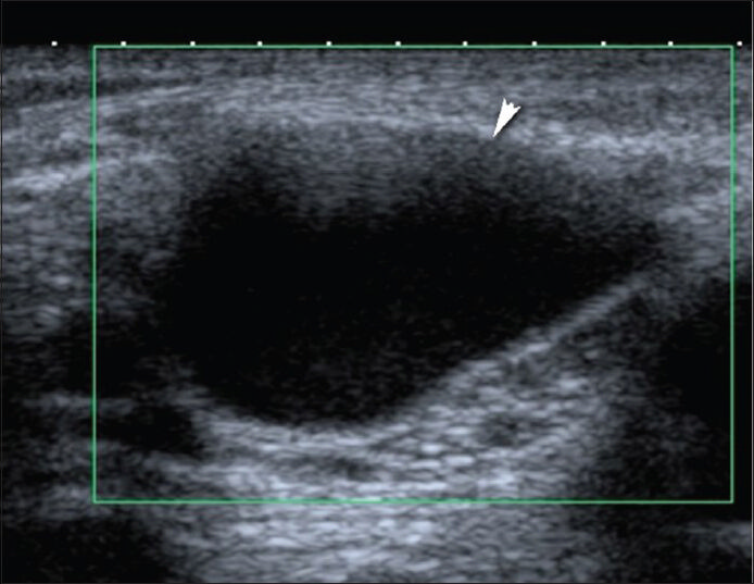 Avascular Baker's cyst in popliteal fossa. Transverse Doppler US image with Toshiba Applio machine (Toshiba Medical Systems, Tokyo, Japan) using 12-MHz probe demonstrates a 3.5 × 2.5 cm cystic mass.