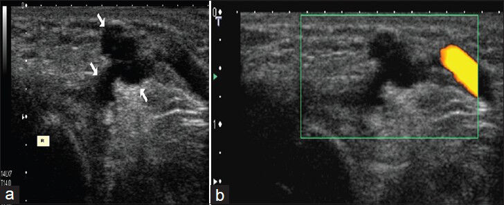 Ganglion cyst in a girl. (a)Transverse US image shows multilobulated anechoic cystic structure (arrows) on the dorsal part of the left wrist. R. distal radius (b) Power Doppler image shows absence of vascularization in the lesion.