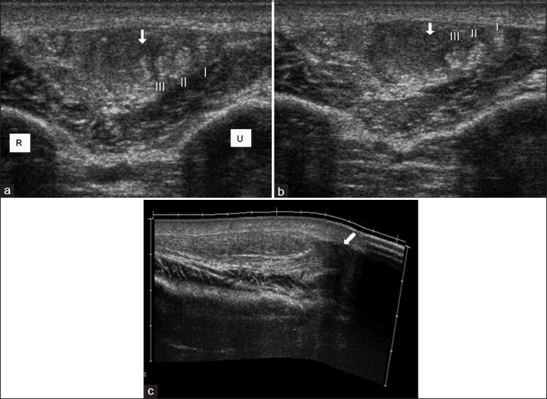 Right extensor carpi radialis brevis tendon rupture in patient with Behçet's disease. (a and b) Contiguous transverse and (c) longitudinal extended field of view sonogram images show partial rupture and hematoma (arrow). (I, II, III; normal appearing other tendons).