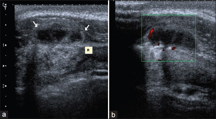 Patient with Brucellosis. (a) Transverse sonogram shows 2 × 1 cm septated complex cystic mass (arrows) adjacent to 6th anterior rib (R). (b) Power Doppler image shows prominent flow around the lesion.