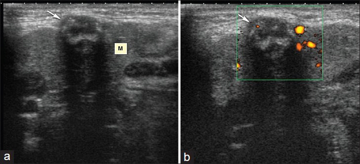 Right submandibular abscess. (a) Longitudinal sonogram shows 1 × 0.5 cm heterogeneous mass containing thick hyperechoic wall and septae in right submandibular gland (M). (b) Power Doppler image shows prominent flow around the lesion.