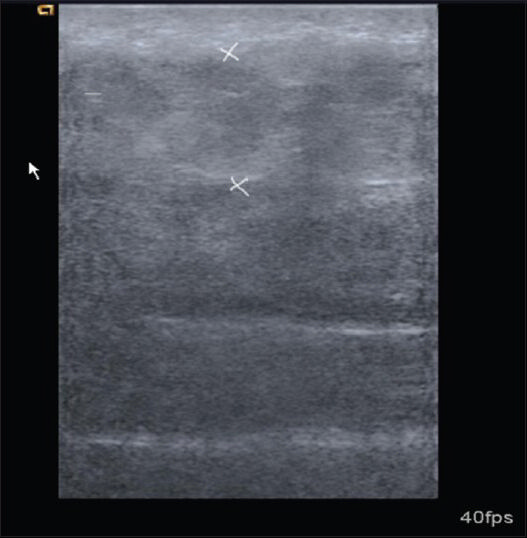 Cellulitis at right femoral region. Transverse sonogram shows thickening of subcutaneous tissues and increase in echogenicity.