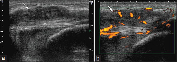 Tenosynovitis in left wrist. (a) Longitudinal sonogram shows hyopoechoic mass around the flexor carpi ulnaris tendon (T) and (b) power Doppler images show vascularization in and around the lesion.