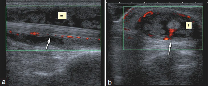 Nonspecific tenosynovitis of flexor carpi radialis. (a) Longitudinal and (b) transverse Doppler US images show vascularization in and around the heterogeneous soft tissue mass. There is also extensive synovitis and fluid (f) and around the tendon.