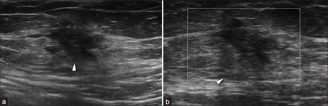 Abdominal wall scar endometriosis. (a) Transverse sonogram shows irregular shaped, hypoechoic solid mass in the subcutanous fat. (b) Power Doppler sonography shows absence of vascularization.