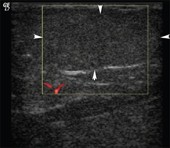 Lipoma. The patient had a painless soft-tissue mass over the right neck. Doppler US shows a 3 × 1 cm soft-tissue mass (arrowheads) within the subcutaneous fat with similar echogenicity to the adjacent fat, without vascularization.