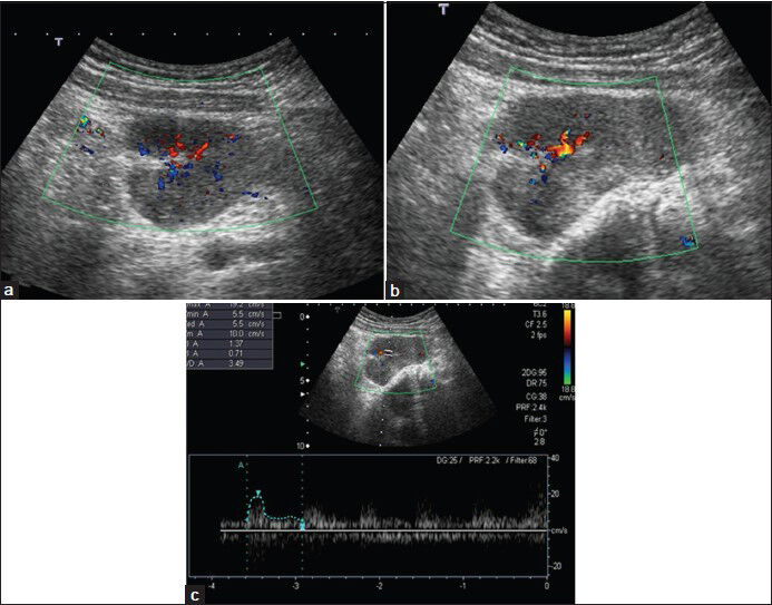 Neurofibroma in a 13-year-old girl. (a) Transverse and (b) longitudinal color Doppler images show hypoechoic solid mass with central vascularization. (c) Spectral Doppler image shows low-resistance arterial flow.