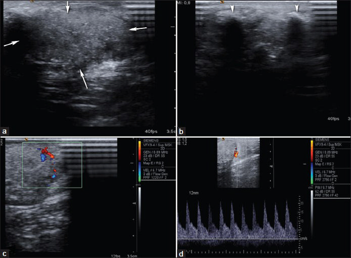 Pilomatricoma. a and b) Transverse sonograms demonstrate a 6 × 4 × 2 cm subcutaneous hyperechoic mass lesion (arrows) with calcifications (arrowheads) at the right shoulder. (c) Color Doppler US demonstrates internal vascularity and (d) spectral Doppler US demonstrates arterial flow in the lesion.