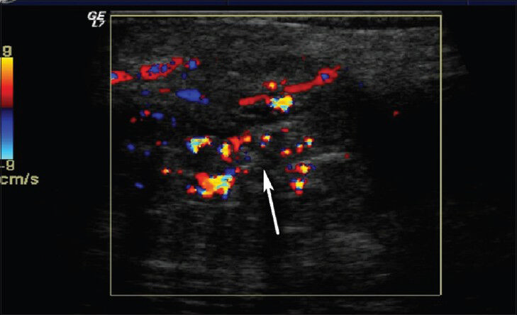 Hemangioma in left thigh. Color Doppler US shows heterogeneous hypoechoic soft tissue mass with prominent vascularization in the subcutaneous area.