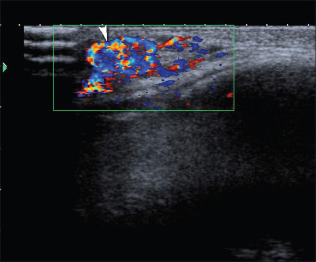 Hemangioma. Color Doppler image reveals a highly vascular mass consistent with capillary hemangioma at the superolateral margin of the right orbit.