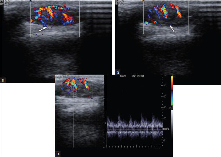 Basal cell carcinoma. (a and b) Color Doppler and (c) spectral Doppler images show a hypervascular hypoechoic mass lesion with arterial waveform at the right occipital region. Histopathological diagnosis was pigmented basal cell carcinoma.