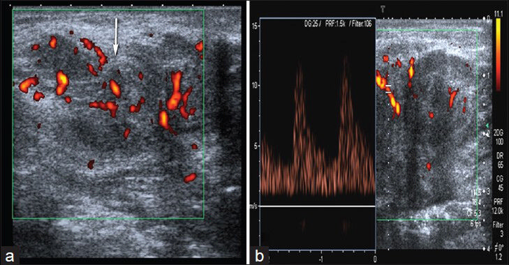 Skin metastases of gastric carcinoma. (a) Power Doppler image shows irregular shaped, hypoechoic soft tissue mass with internal vascularity. (b) Spectral Doppler US demonstrates arterial flow in the lesion.