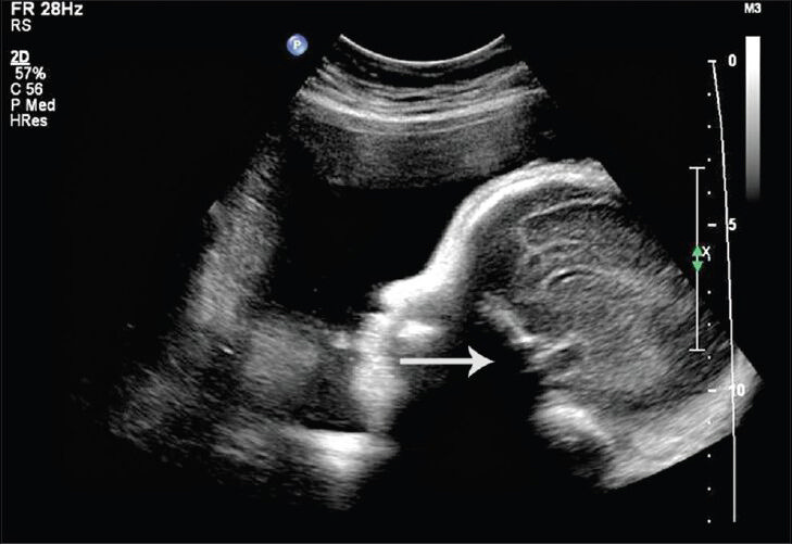 25-year-old female with gravida 2 para 1 evaluated for polyhydraminos. Fetus was later diagnosed with oropharyngeal teratoma. Ultrasound image of fetal face in sagittal projection shows shadow from the hard palate (arrow) obscuring the pharyngeal mass.