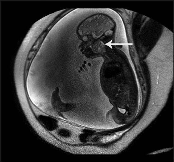25-year-old female with gravida 2 para 1 evaluated for polyhydraminos. Fetus was later diagnosed with oropharyngeal teratoma. Sagittal image of Fetal MRI at 34 weeks gestation shows well-defined mixed intensity lesion with cystic component measuring about 4.5 × 3.5 cm in oropharyngeal region (arrow).
