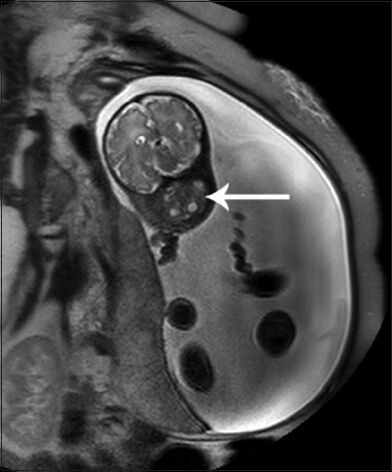25-year-old female with gravida 2 para 1 evaluated for polyhydraminos. Fetus was later diagnosed with oropharyngeal teratoma. Axial image of Fetal MRI at 34 weeks of gestation shows well-defined mixed intensity lesion with cystic component measuring about 4.5 × 3.5 cm in oropharyngeal region (arrow).