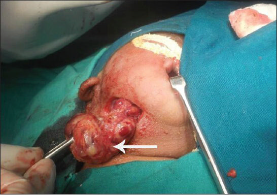 25-year-old female with gravida 2 para 1 evaluated for polyhydraminos. Fetus was diagnosed with oropharyngeal teratoma. Photograph during surgery shows the tumor mass (arrow).