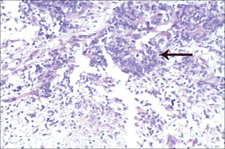 25-year-old female with gravida 2 para 1 evaluated for polyhydraminos. Fetus was diagnosed with oropharyngeal teratoma. Histopathology examination of the surgically removed mass shows mass composed of mature and immature elements of teratoma. Easiest immature element to identify is neuroepithelium with columnar cells forming rossettes and tubules (arrow). Tissue stained with hematoxylin and eosin, ×40.