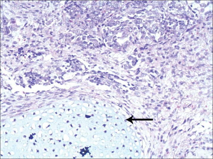 25-year-old female with gravida 2 para 1 evaluated for polyhydraminos. Fetus was diagnosed with oropharyngeal teratoma. Surgically removed mass stained with hematoxylin and eosin at ×45 shows mature cartilaginous tissue (arrow).
